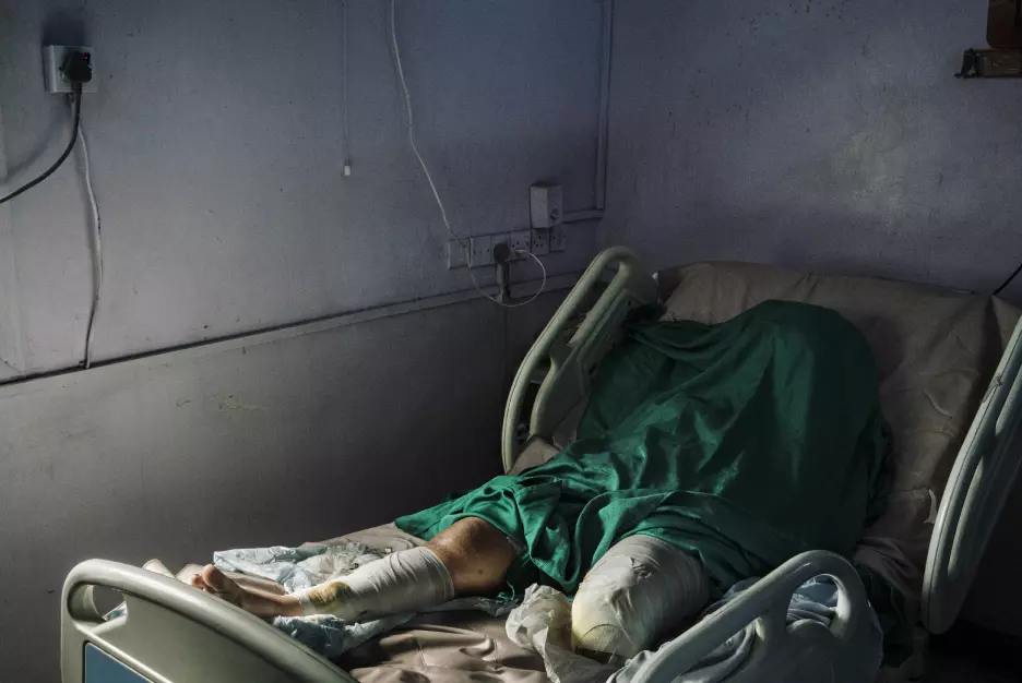 Wafa Ahmed Hathim (25) mistet sitt venstre ben når en mørtel landet på huset hennes i den strategisk viktige Rødehavshavnen i Hudaydah 8. desember - samtidig som det det pågikk langvarige fredsforhandlinger i Sverige. Foto: Lorenzo Tugnoli / Contrasto, for The Washington Post