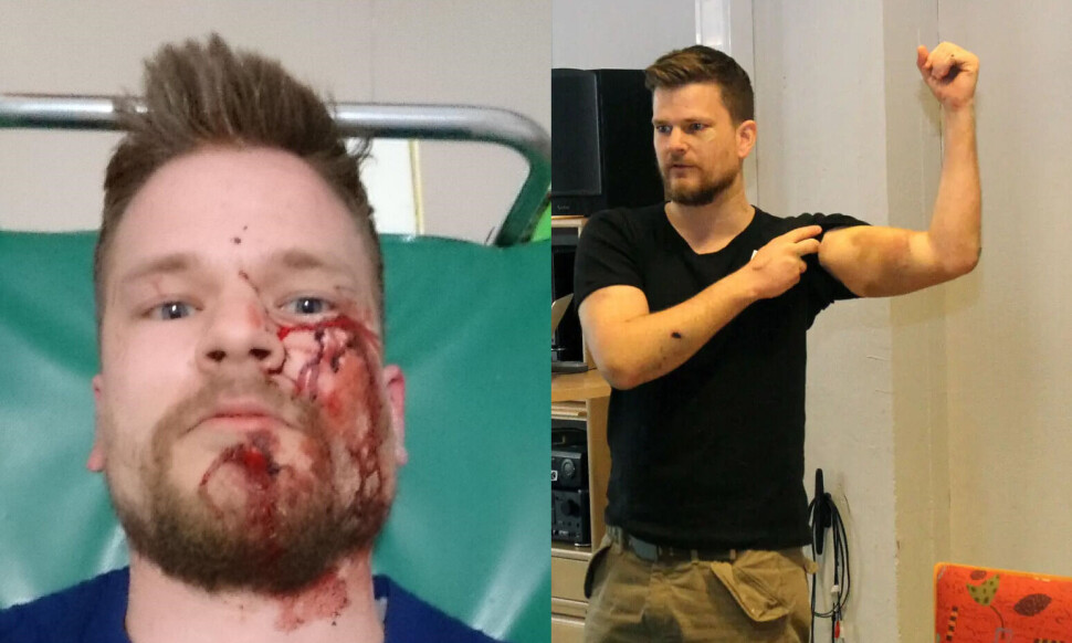 Ble brutalt angrepet i 2016 – nå får Øystein Windstad erstatning